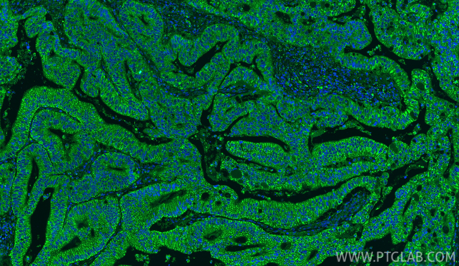 IF Staining of human colon cancer using 11780-1-AP