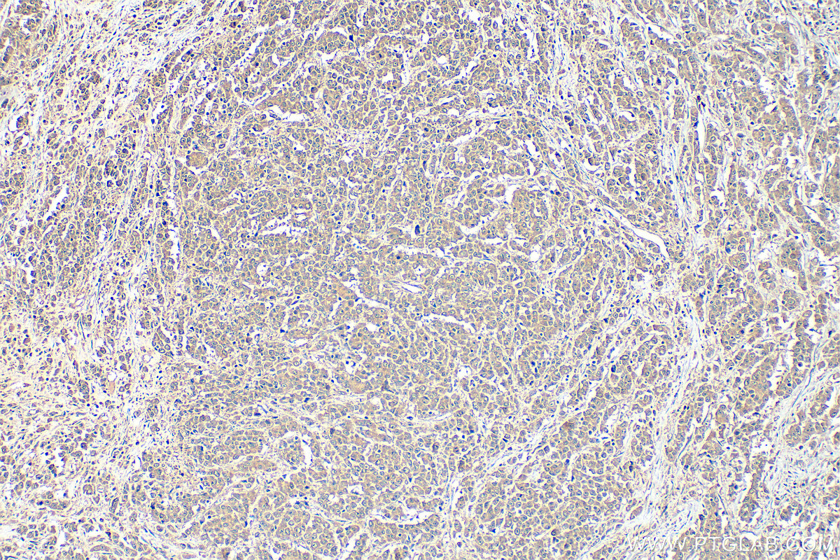 Immunohistochemical analysis of paraffin-embedded human colon cancer tissue slide using 11780-1-AP (TRAF7 antibody) at dilution of 1:600 (under 10x lens). Heat mediated antigen retrieval with Tris-EDTA buffer (pH 9.0). IHC staining of human colon cancer using 11780-1-AP