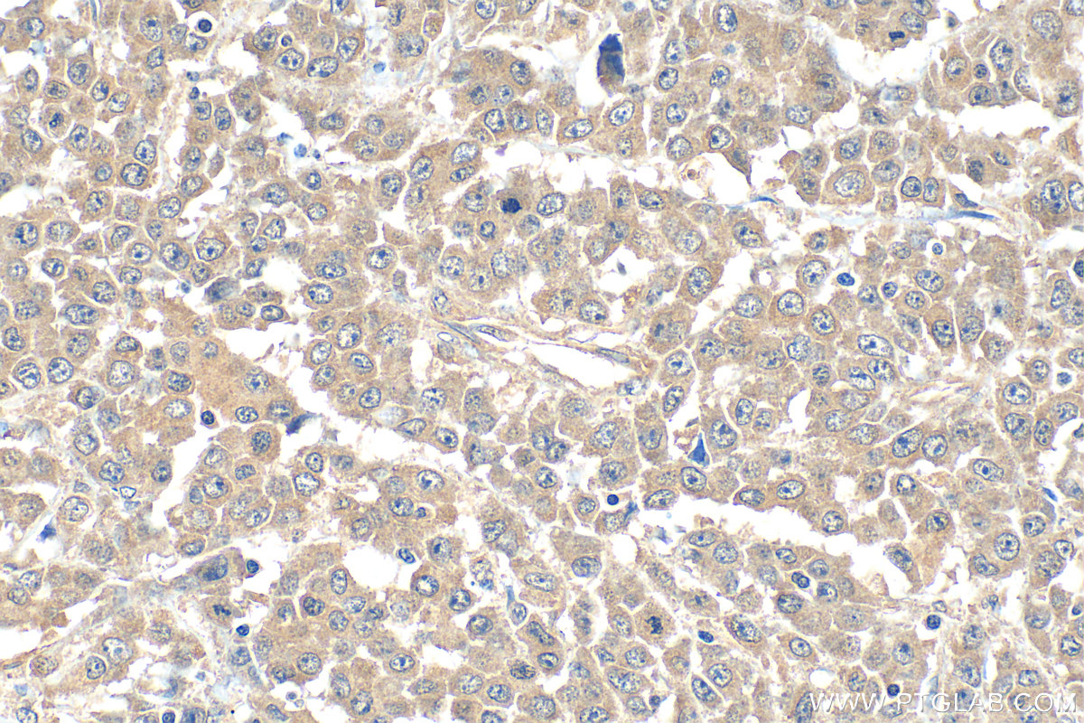 Immunohistochemical analysis of paraffin-embedded human colon cancer tissue slide using 11780-1-AP (TRAF7 antibody) at dilution of 1:600 (under 40x lens). Heat mediated antigen retrieval with Tris-EDTA buffer (pH 9.0). IHC staining of human colon cancer using 11780-1-AP