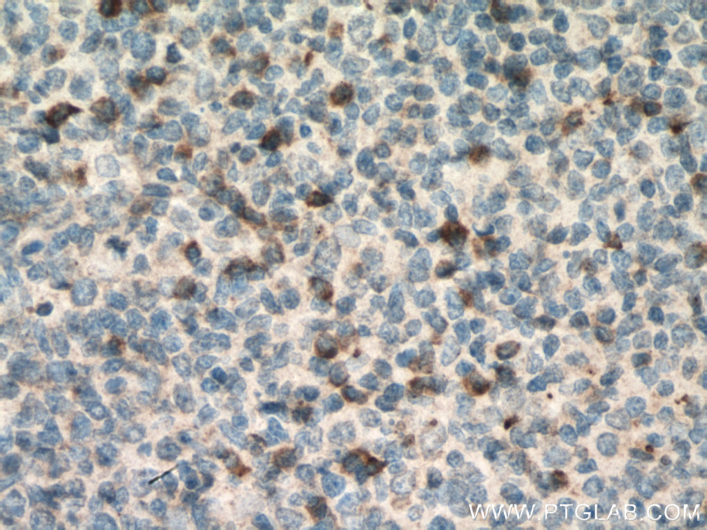 IHC staining of human tonsillitis using 66756-1-Ig