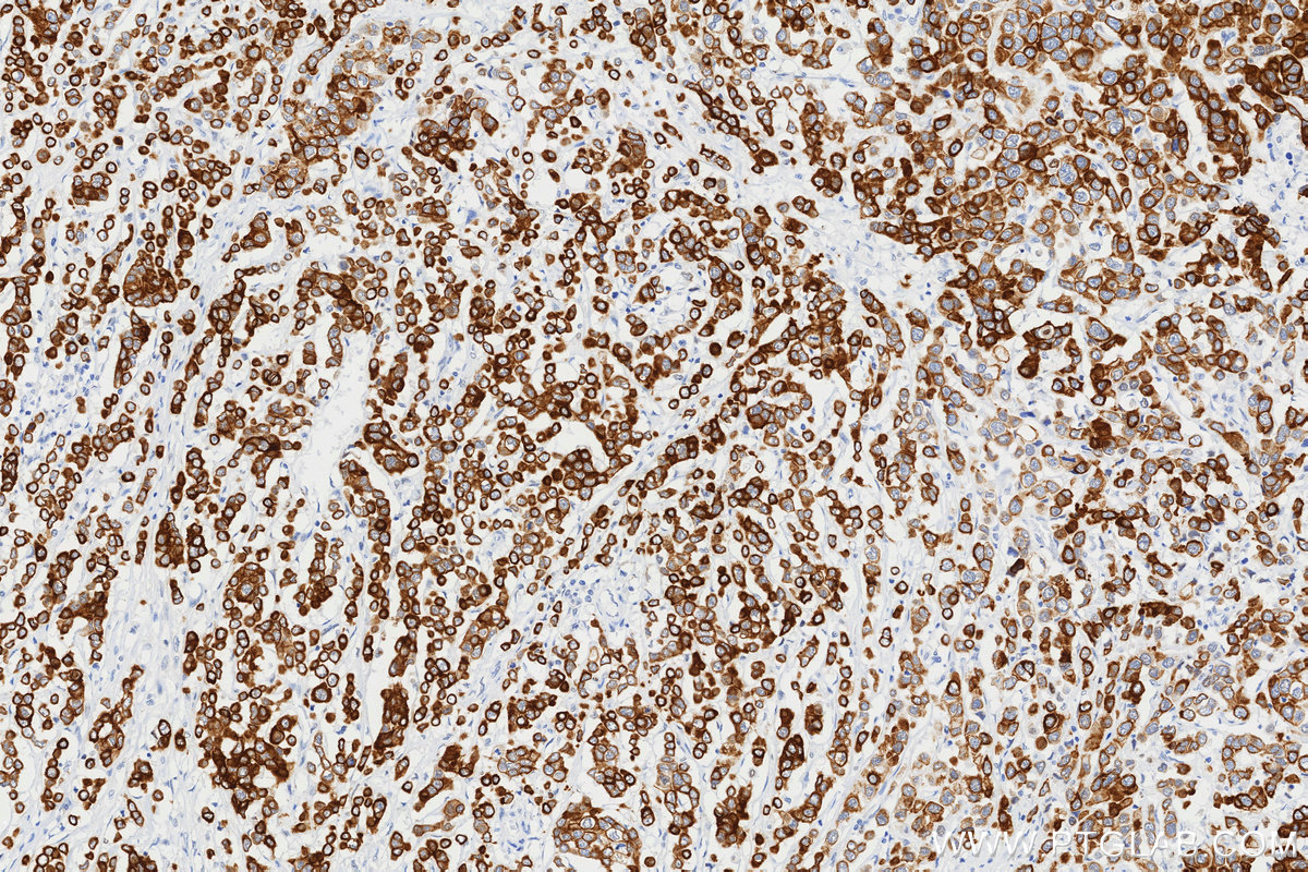 IHC staining of human breast cancer using 86808-1-RR (same clone as 86808-1-PBS)