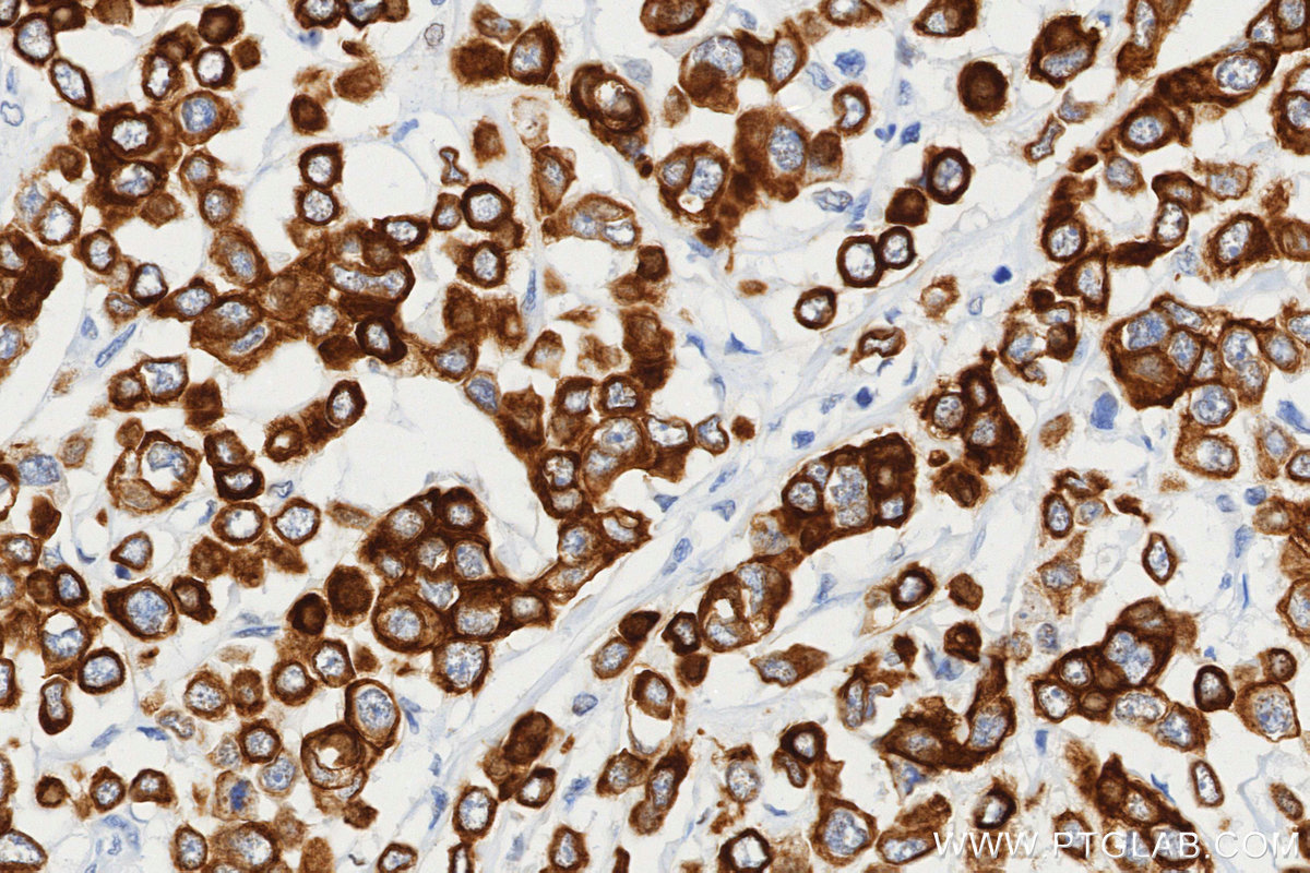 IHC staining of human breast cancer using 86808-1-RR (same clone as 86808-1-PBS)