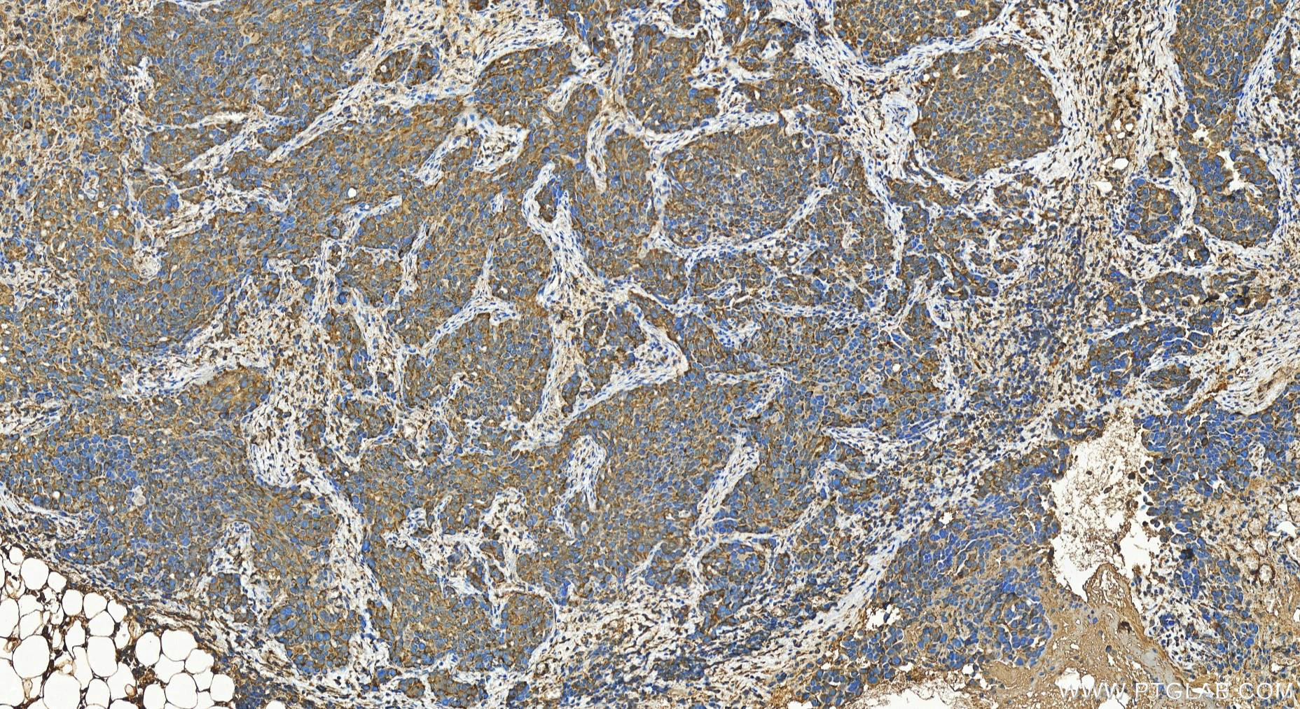 IHC staining of human ovary cancer using 27583-1-AP IHC staining of human ovary cancer using 27583-1-AP