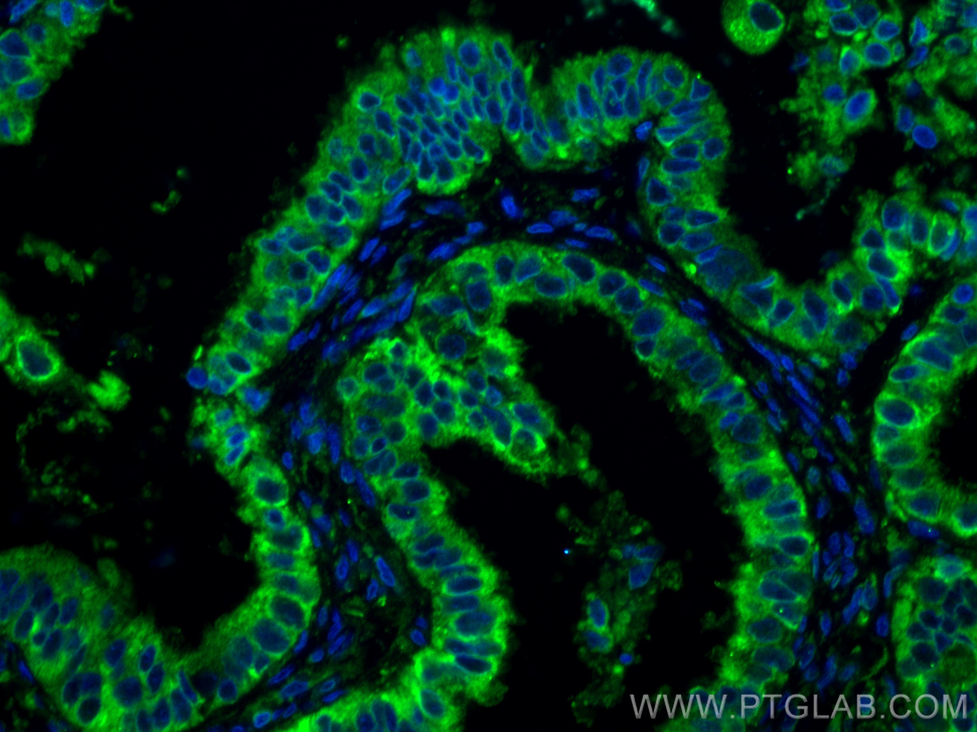 IF Staining of human ovary tumor using 67925-1-Ig (same clone as 67925-1-PBS)