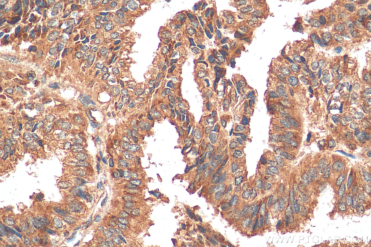 IHC staining of human ovary tumor using 67925-1-Ig (same clone as 67925-1-PBS)