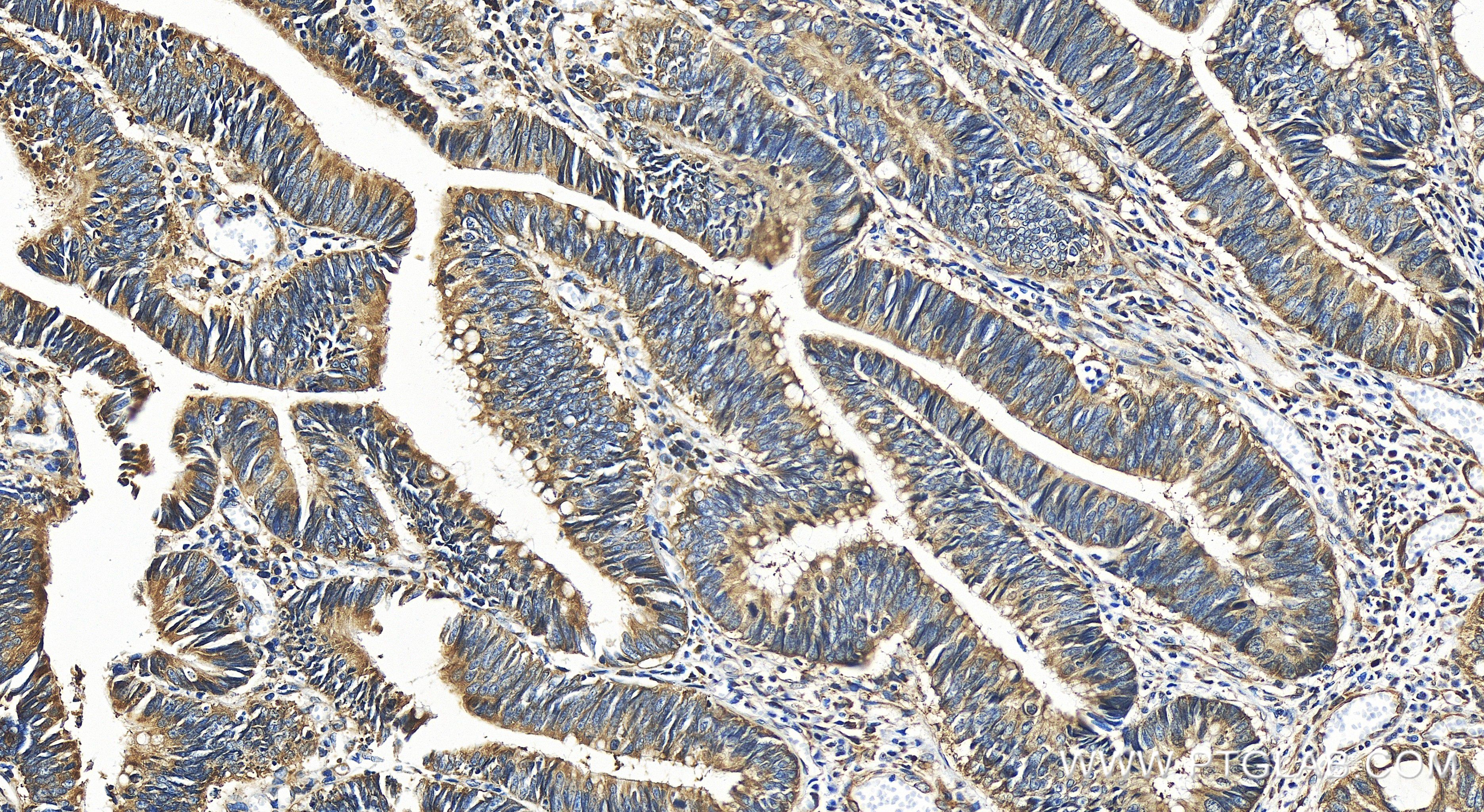 IHC staining of human colon cancer using 84119-3-RR