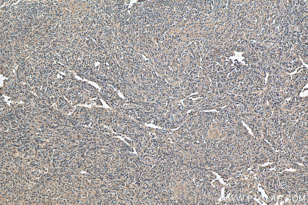 IHC staining of human lymphoma using 13132-1-AP