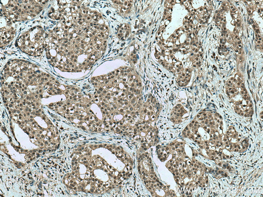 IHC staining of human breast cancer using 66792-1-Ig