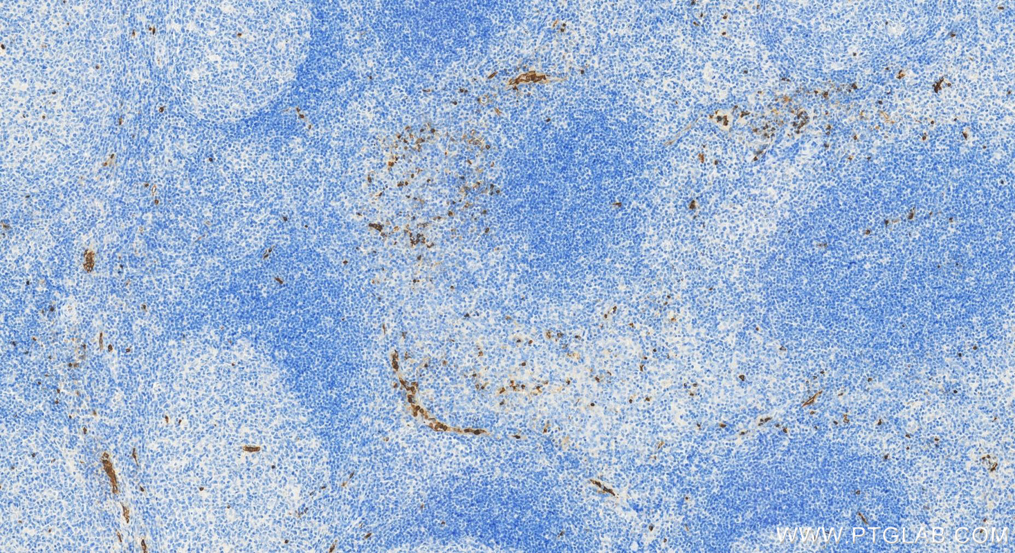 IHC staining of human tonsillitis using 11791-1-AP