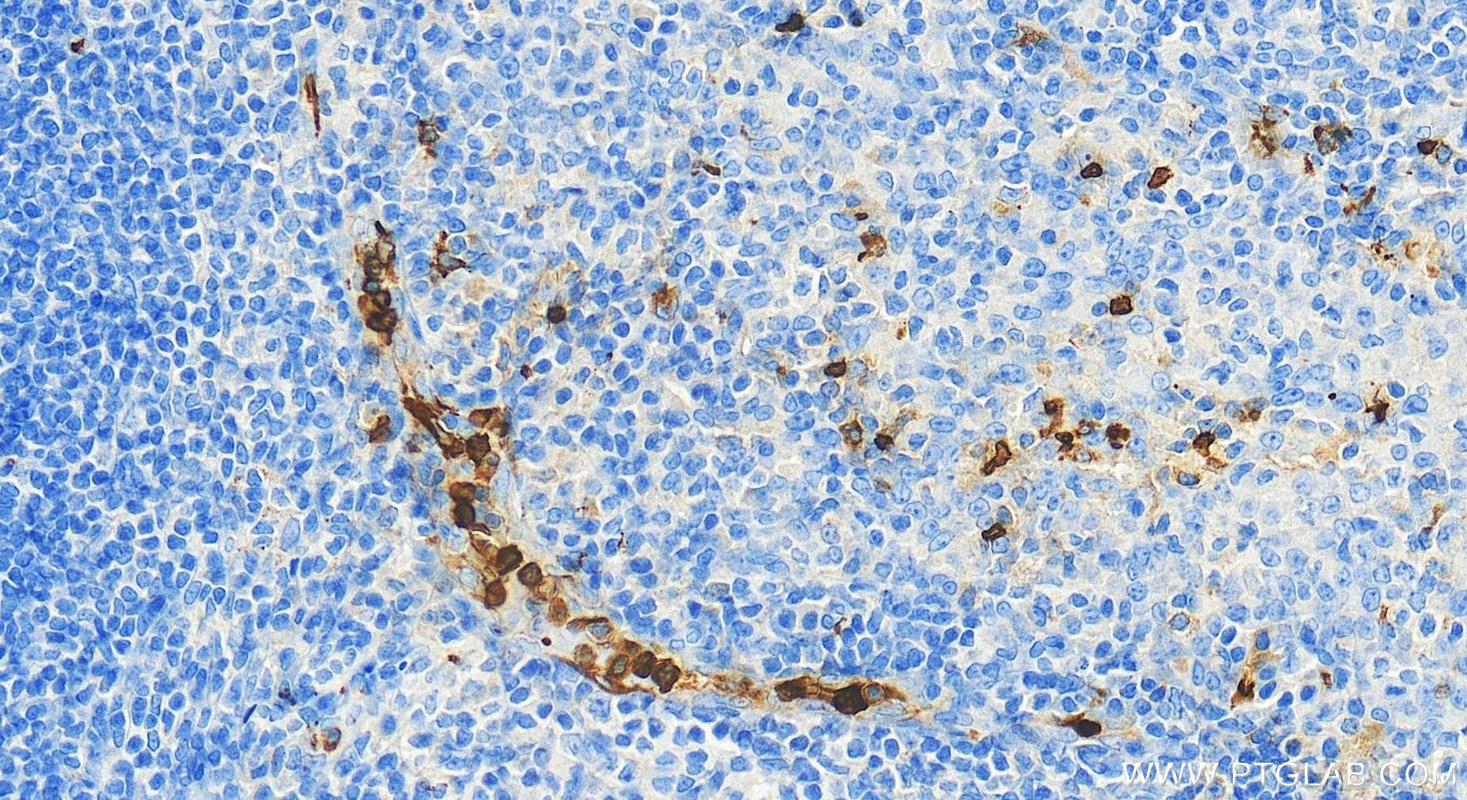 IHC staining of human tonsillitis using 11791-1-AP