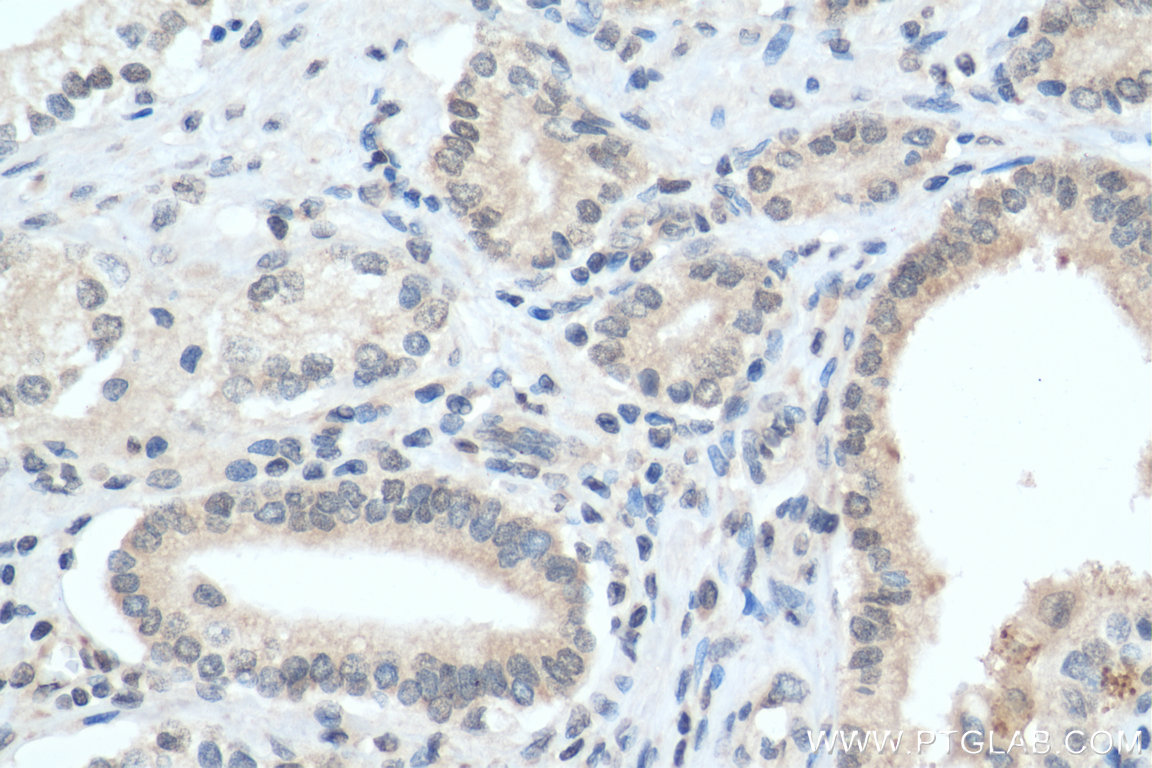 Immunohistochemical analysis of paraffin-embedded human prostate cancer tissue slide using 27899-1-AP (TRIB1 antibody) at dilution of 1:200 (under 40x lens). Heat mediated antigen retrieval with Tris-EDTA buffer (pH 9.0). IHC staining of human prostate cancer using 27899-1-AP