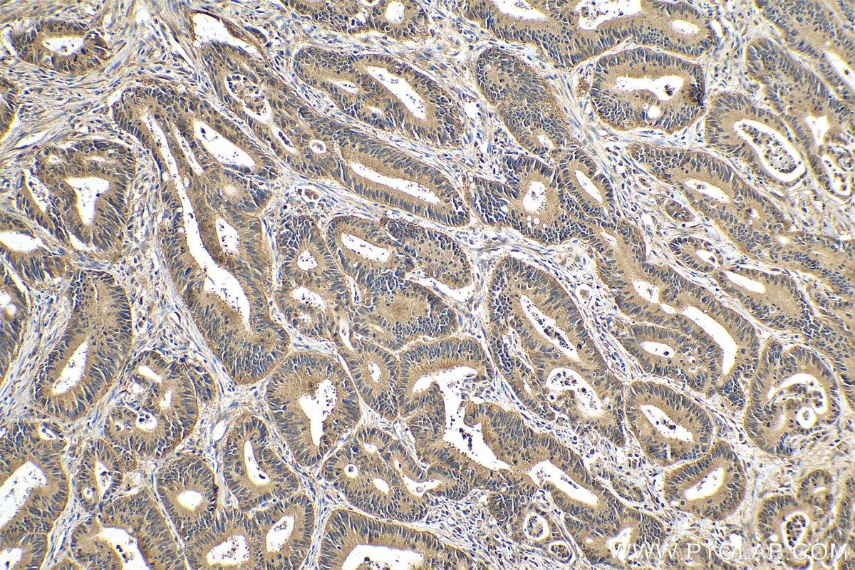 IHC staining of human colon cancer using 10851-1-AP