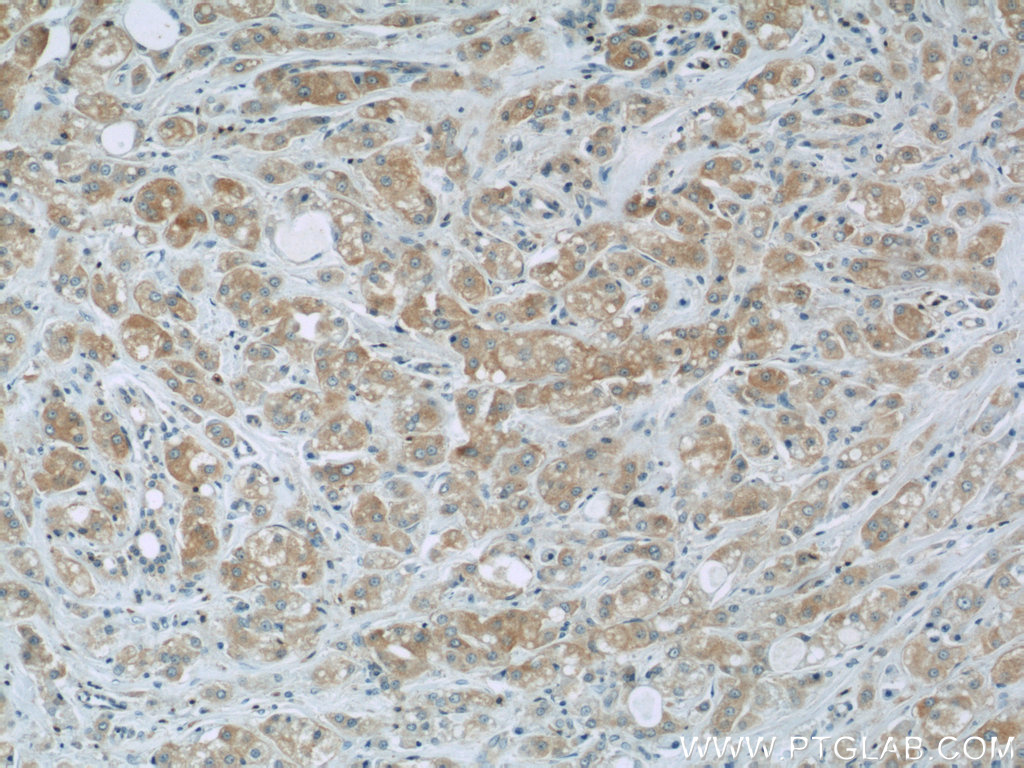 IHC staining of human breast cancer using 22021-1-AP