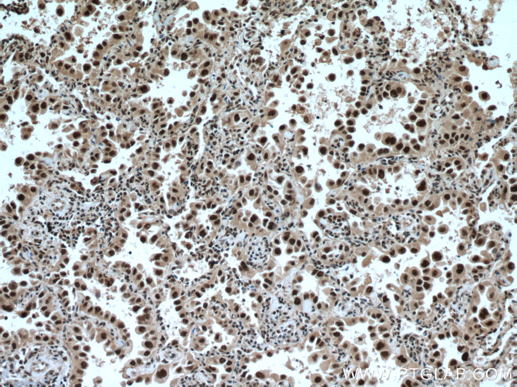 IHC staining of human lung cancer using 13744-1-AP