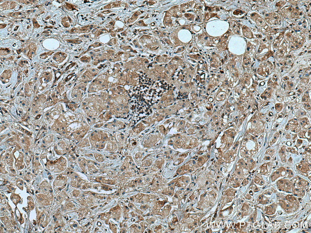 IHC staining of human breast cancer using 67314-1-Ig (same clone as 67314-1-PBS)