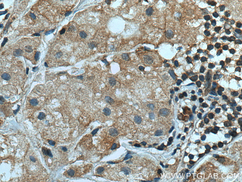 IHC staining of human breast cancer using 67314-1-Ig (same clone as 67314-1-PBS)