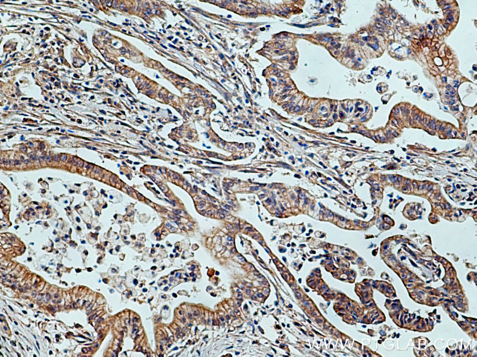 IHC staining of human pancreas cancer using 27013-1-AP