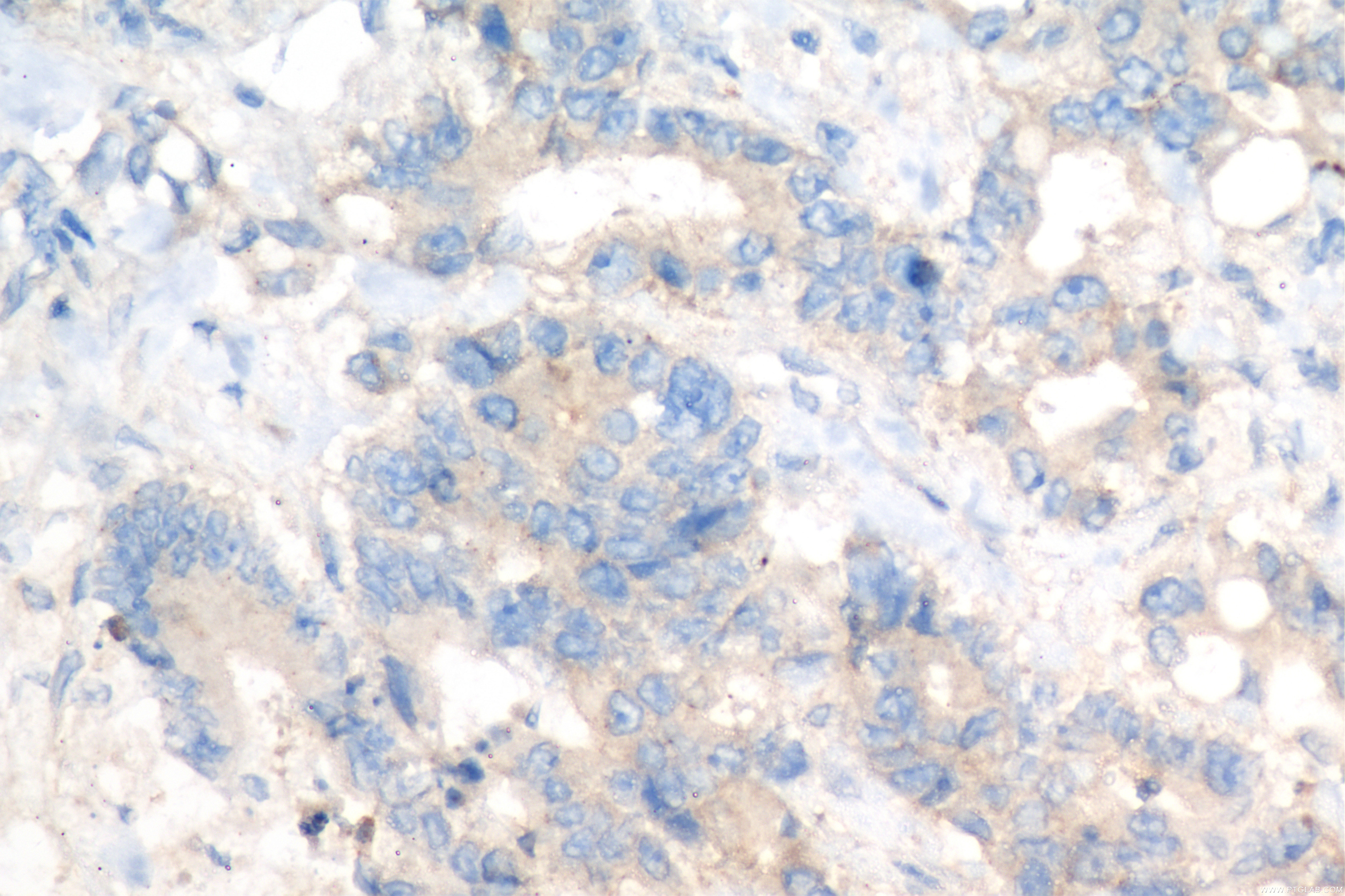 IHC staining of human rectal cancer using 84661-4-RR (same clone as 84661-4-PBS)