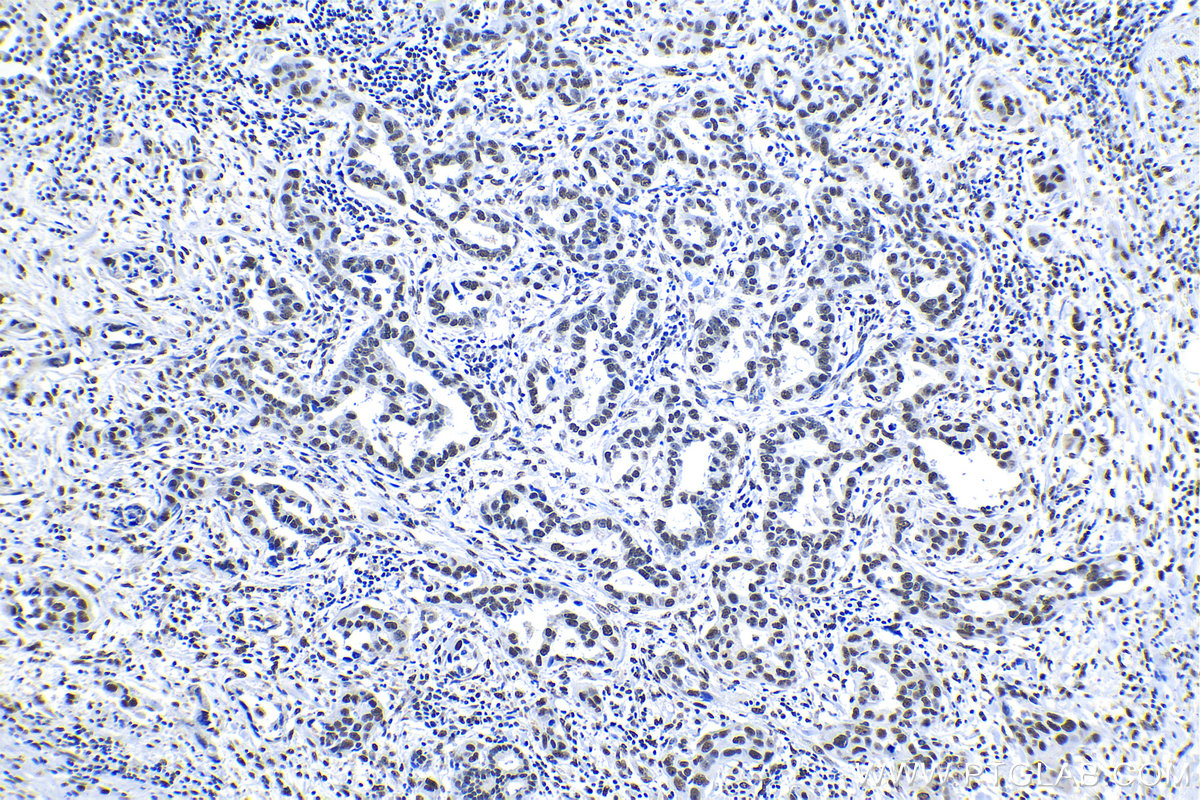 IHC staining of human lung cancer using 15202-1-AP