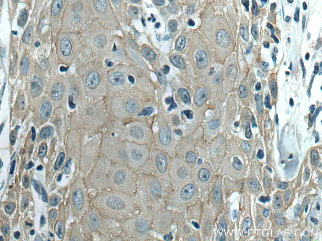 IHC staining of human skin cancer using 17542-1-AP