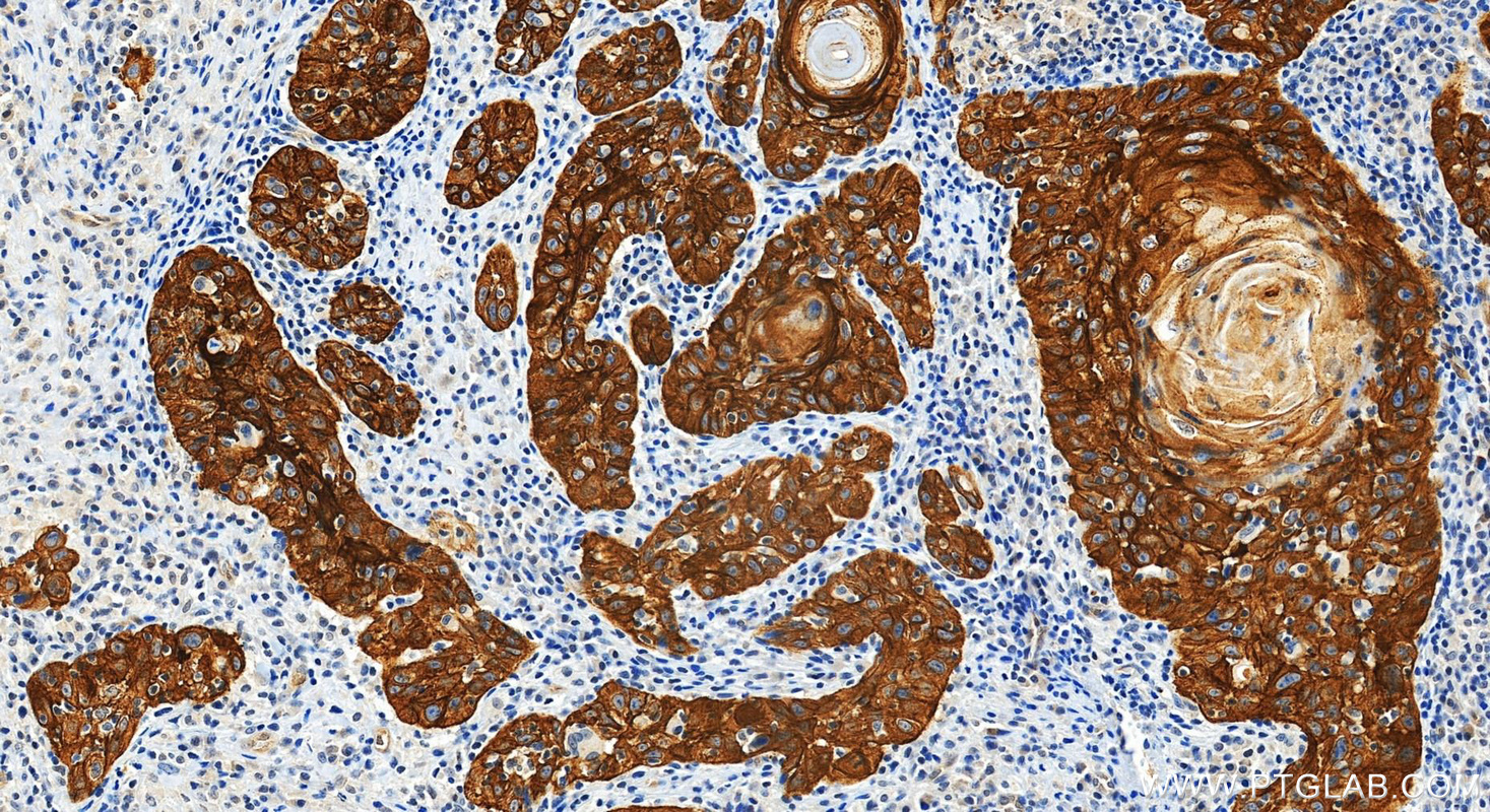 IHC staining of human skin cancer using RMX00086