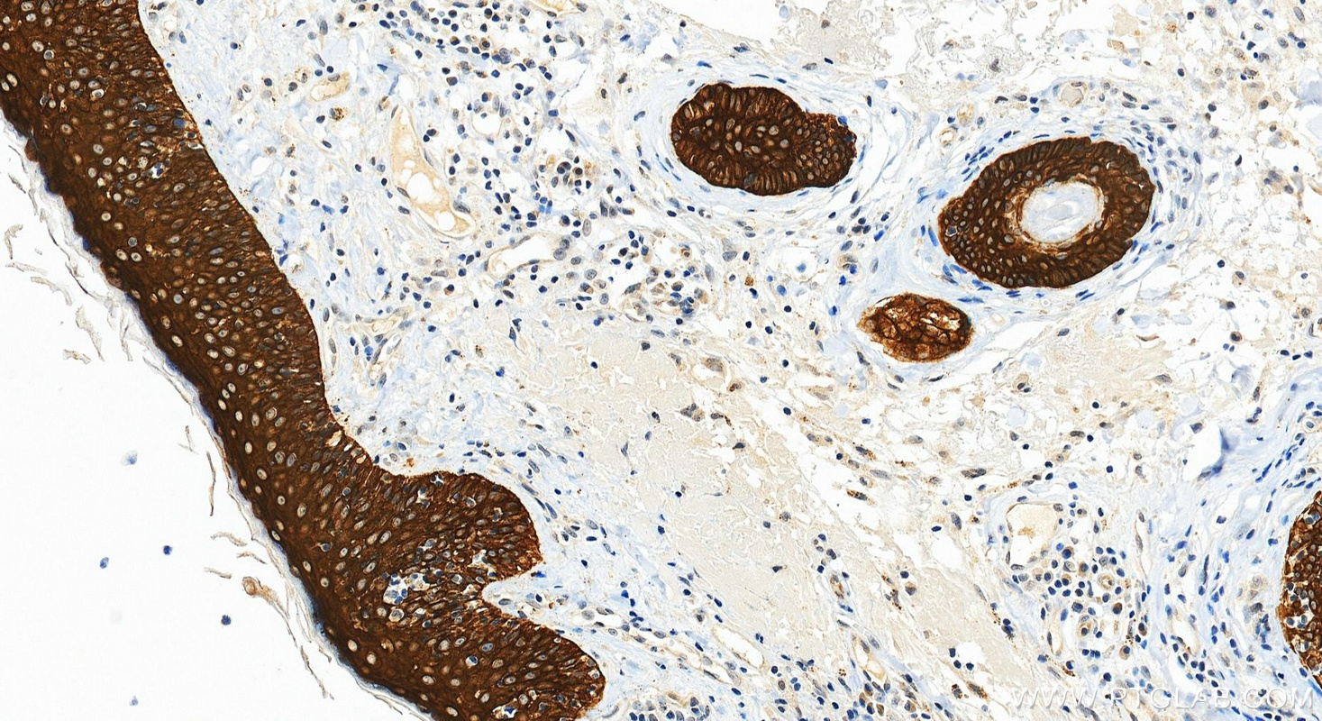 IHC staining of human skin cancer using RMX00086