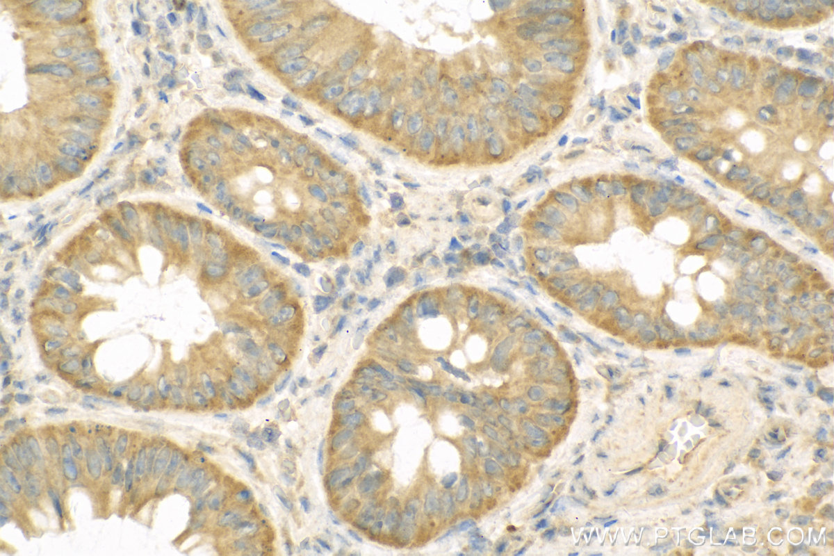 IHC staining of Human Colon cancer using 12543-1-AP