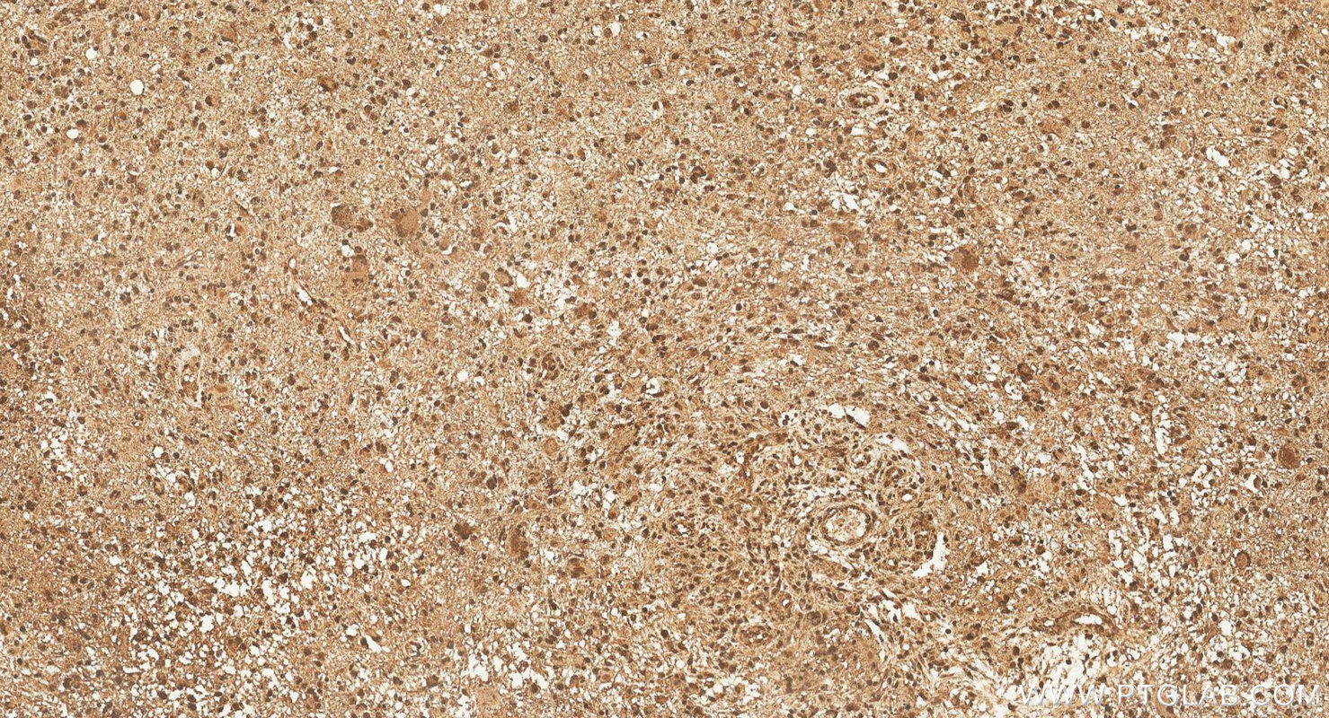 IHC staining of human gliomas using 11511-1-AP IHC staining of human gliomas using 11511-1-AP