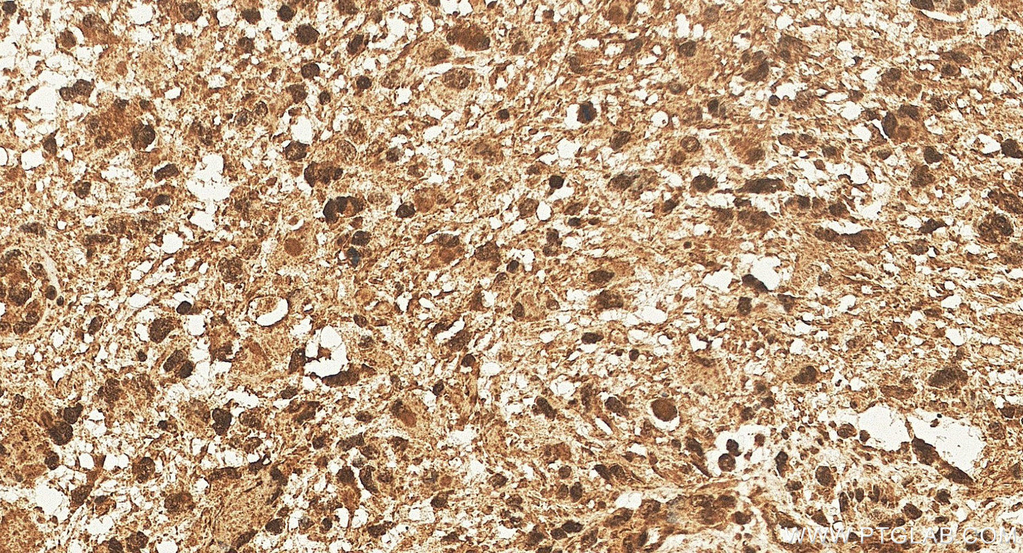 IHC staining of human gliomas using 11511-1-AP IHC staining of human gliomas using 11511-1-AP