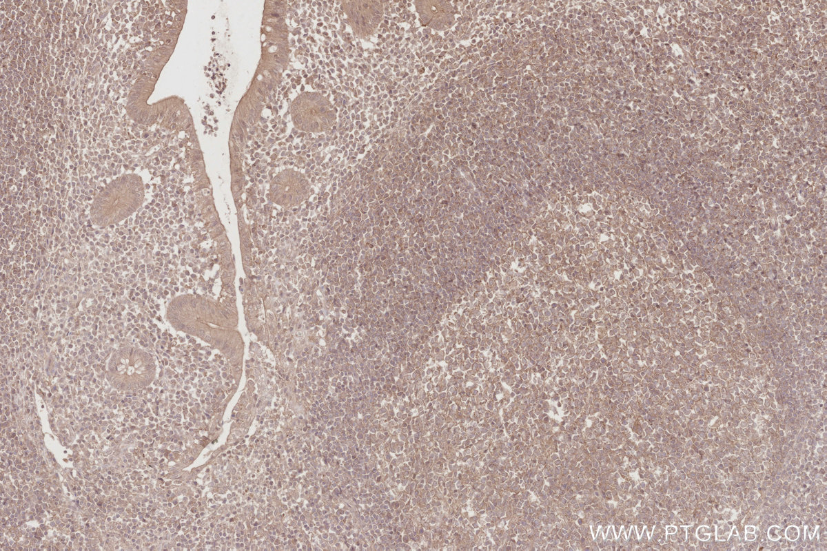 IHC staining of human appendicitis using 67492-1-Ig IHC staining of human appendicitis using 67492-1-Ig