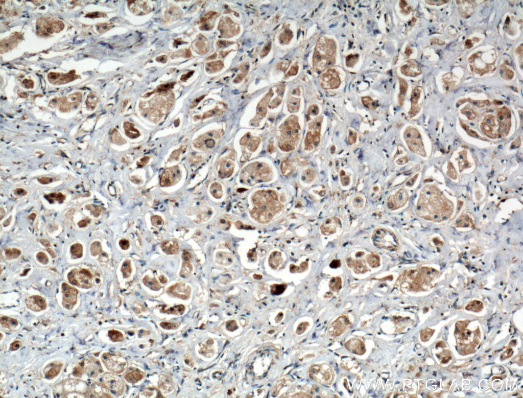 IHC staining of human breast cancer using 27463-1-AP
