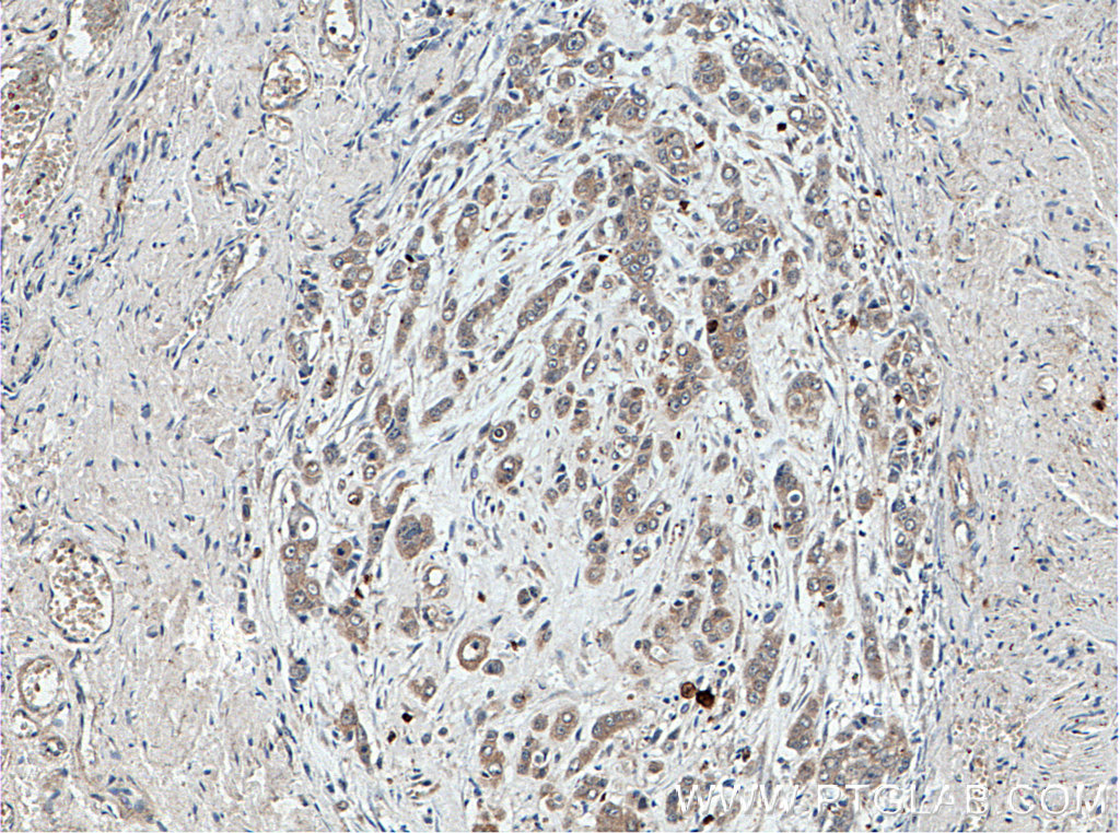 IHC staining of human colon cancer using 14970-1-AP