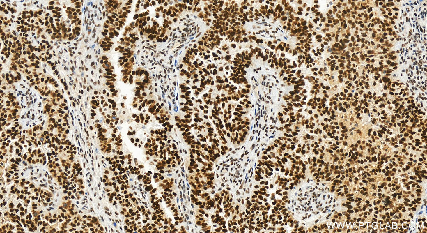 IHC staining of human ovarian  cancer using 83843-5-RR