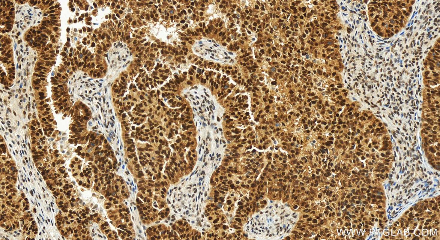 IHC staining of human ovarian  cancer using 83843-6-RR