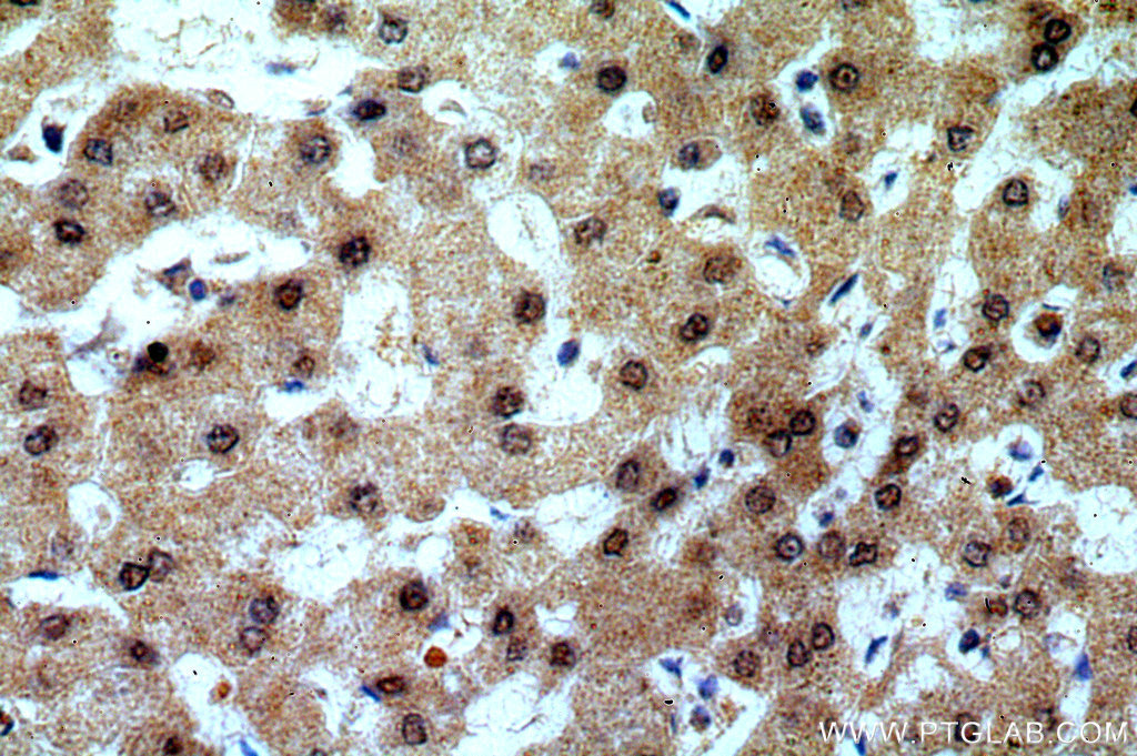 IHC staining of human hepatocirrhosis using 15053-1-AP