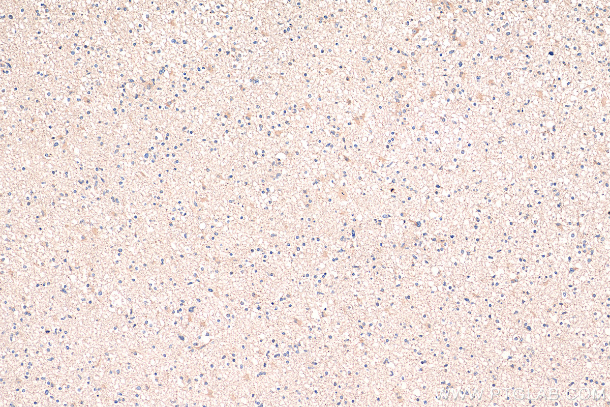 IHC staining of human gliomas using 13634-1-AP