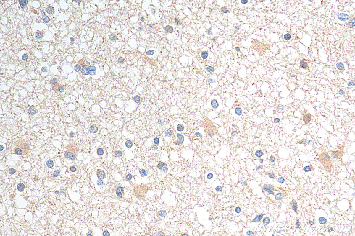 IHC staining of human gliomas using 13634-1-AP