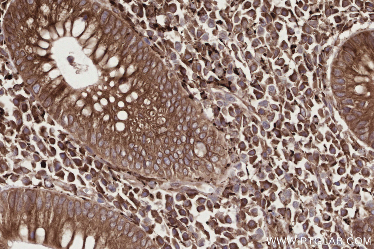 IHC staining of human appendicitis using 29310-1-AP