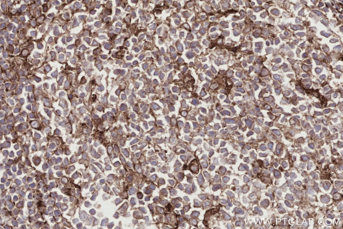 IHC staining of human appendicitis using 29310-1-AP