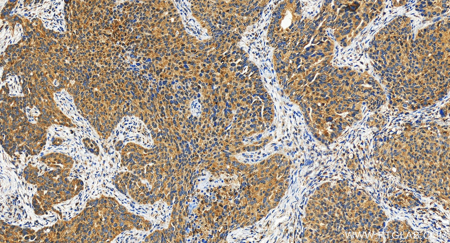 IHC staining of human ovary cancer using 29310-1-AP