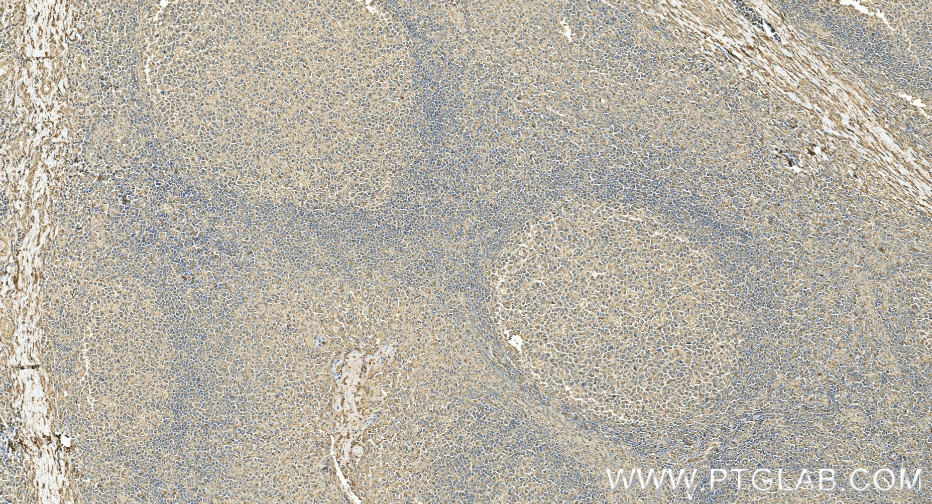 Immunohistochemical analysis of paraffin-embedded human tonsillitis tissue slide using <a class='green' href='/productredirect?CatalogNo=98602-3-RR' target='_blank'>98602-3-RR</a> (TRPM7 antibody) at dilution of 1:1000 (under 20x lens). Heat mediated antigen retrieval with Tris-EDTA buffer (pH 9.0). This data was developed using the same antibody clone with 98602-3-PBS in a different storage buffer formulation. IHC staining of human tonsillitis using 98602-3-RR (same clone as 98602-3-PBS)