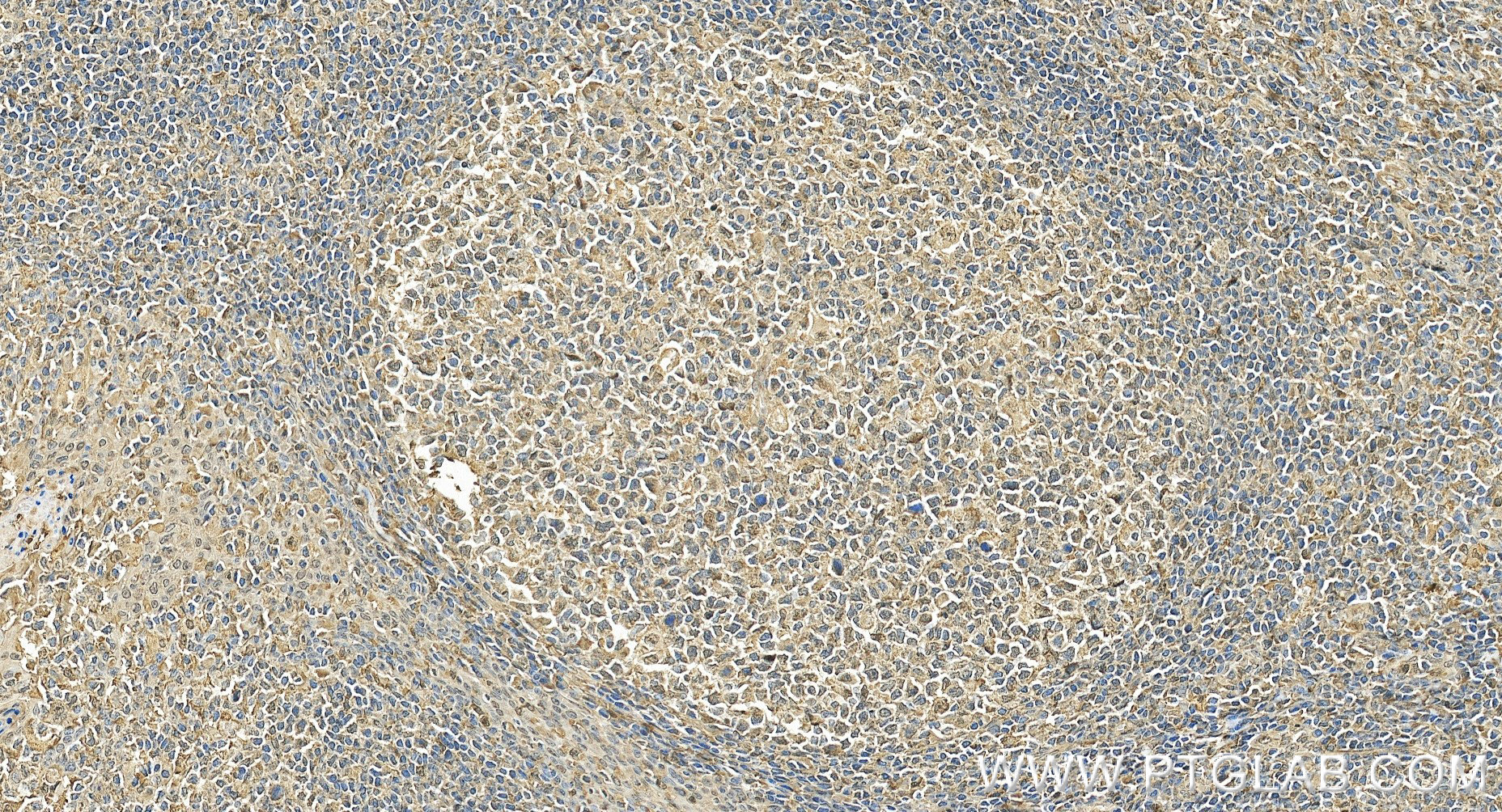 Immunohistochemical analysis of paraffin-embedded human tonsillitis tissue slide using <a class='green' href='/productredirect?CatalogNo=98602-3-RR' target='_blank'>98602-3-RR</a> (TRPM7 antibody) at dilution of 1:1000 (under 20x lens). Heat mediated antigen retrieval with Tris-EDTA buffer (pH 9.0). This data was developed using the same antibody clone with 98602-3-PBS in a different storage buffer formulation. IHC staining of human tonsillitis using 98602-3-RR (same clone as 98602-3-PBS)