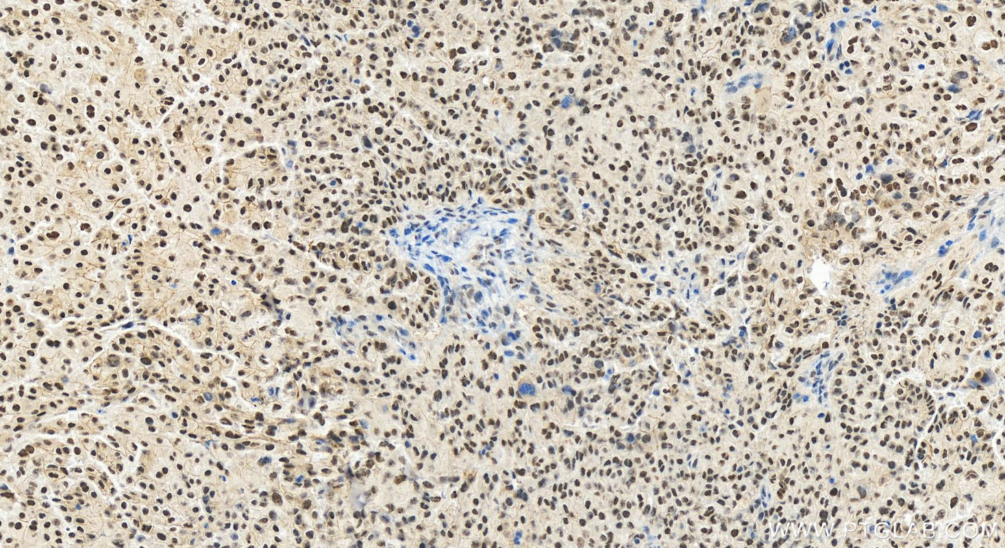IHC staining of human ovary cancer using 28753-1-AP