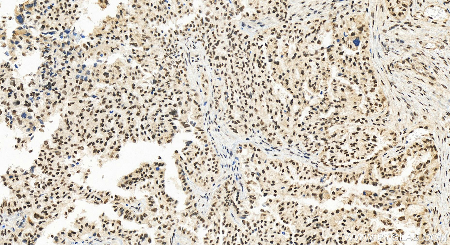 IHC staining of human ovary cancer using 28753-1-AP