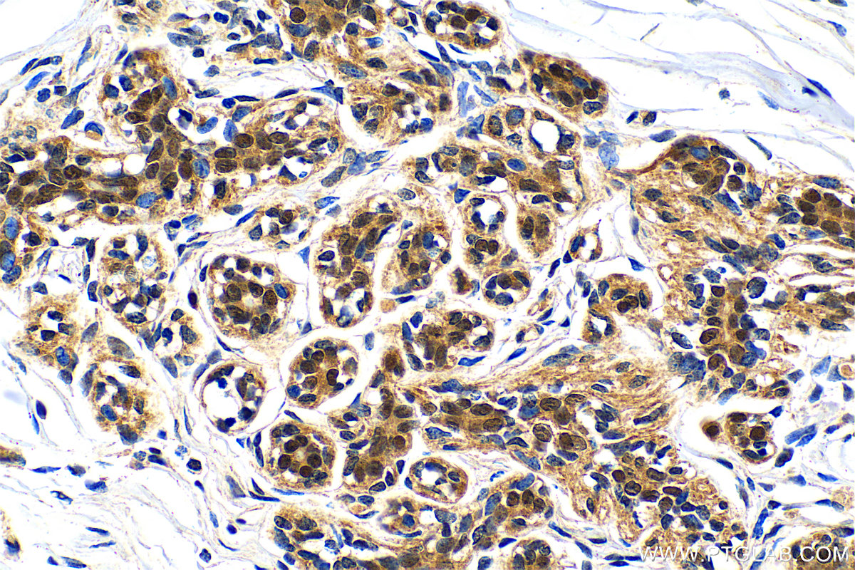 IHC staining of human breast cancer using 83062-4-RR (same clone as 83062-4-PBS)