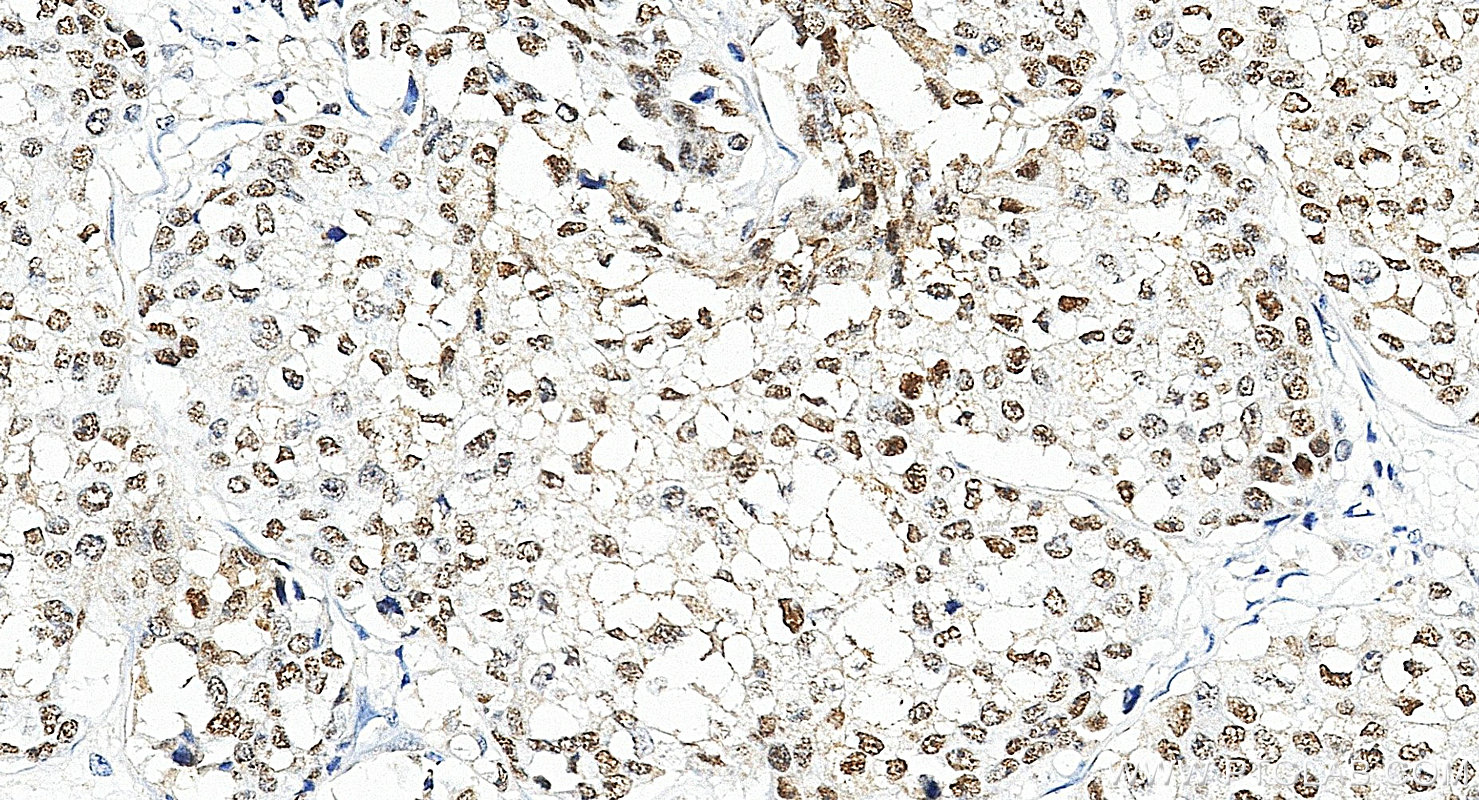 IHC staining of human breast cancer using 83062-4-RR IHC staining of human breast cancer using 83062-4-RR