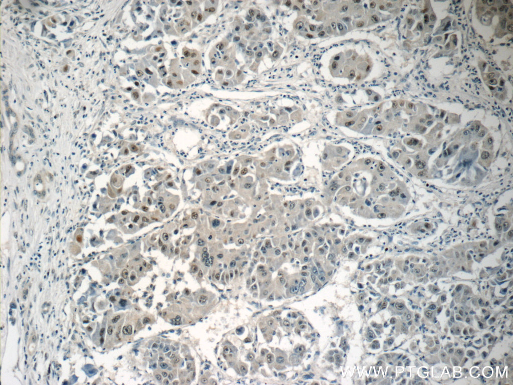 IHC staining of human liver cancer using 15541-1-AP