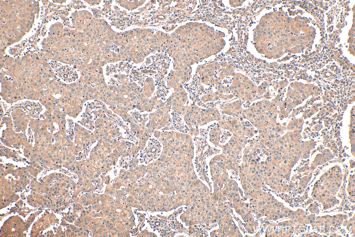 IHC staining of human breast cancer using 29971-1-AP