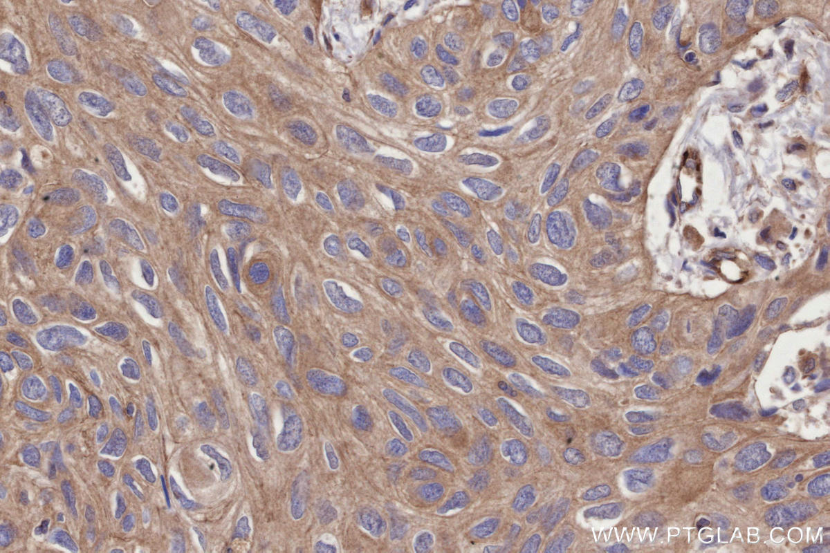 IHC staining of human lung cancer using 29971-1-AP IHC staining of human lung cancer using 29971-1-AP