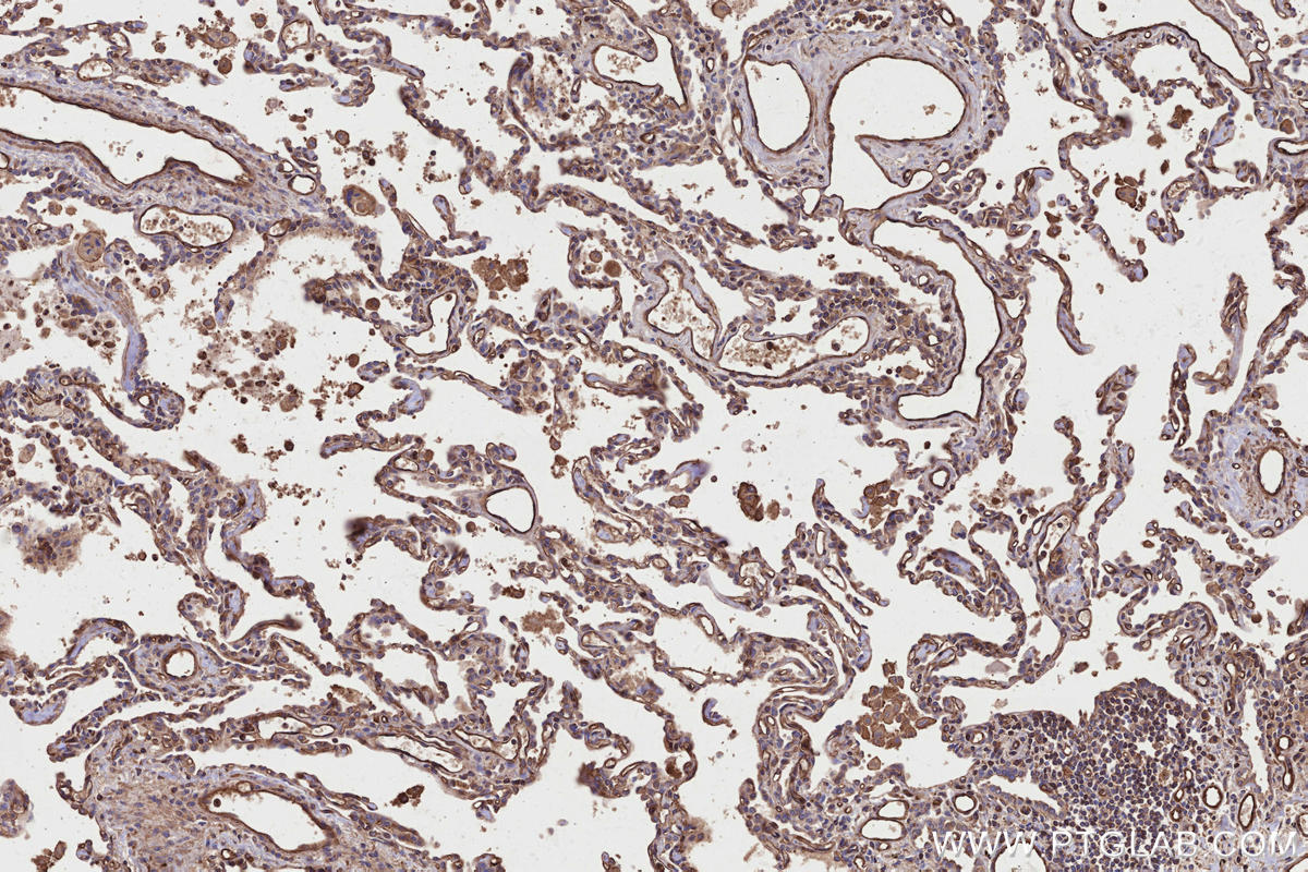 IHC staining of human lung cancer using 29971-1-AP IHC staining of human lung cancer using 29971-1-AP